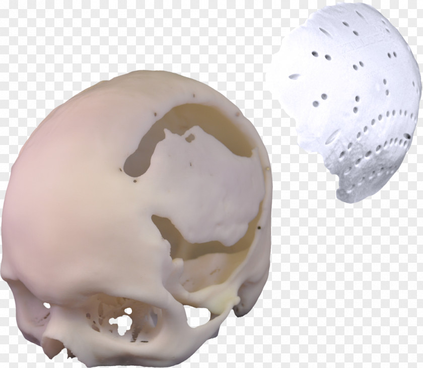 Bone Material 3D Printing Poly Xilloc Implant Plastic PNG