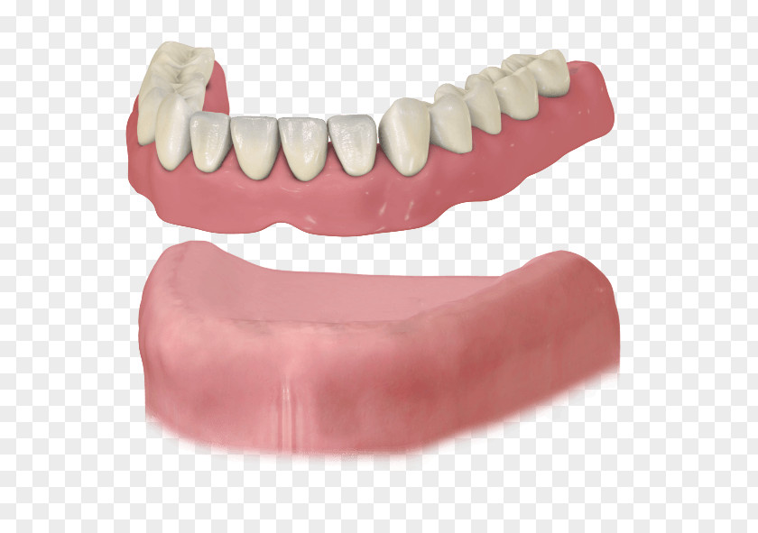 Bridge Dental Implant Dentures Removable Partial Denture Dentistry PNG