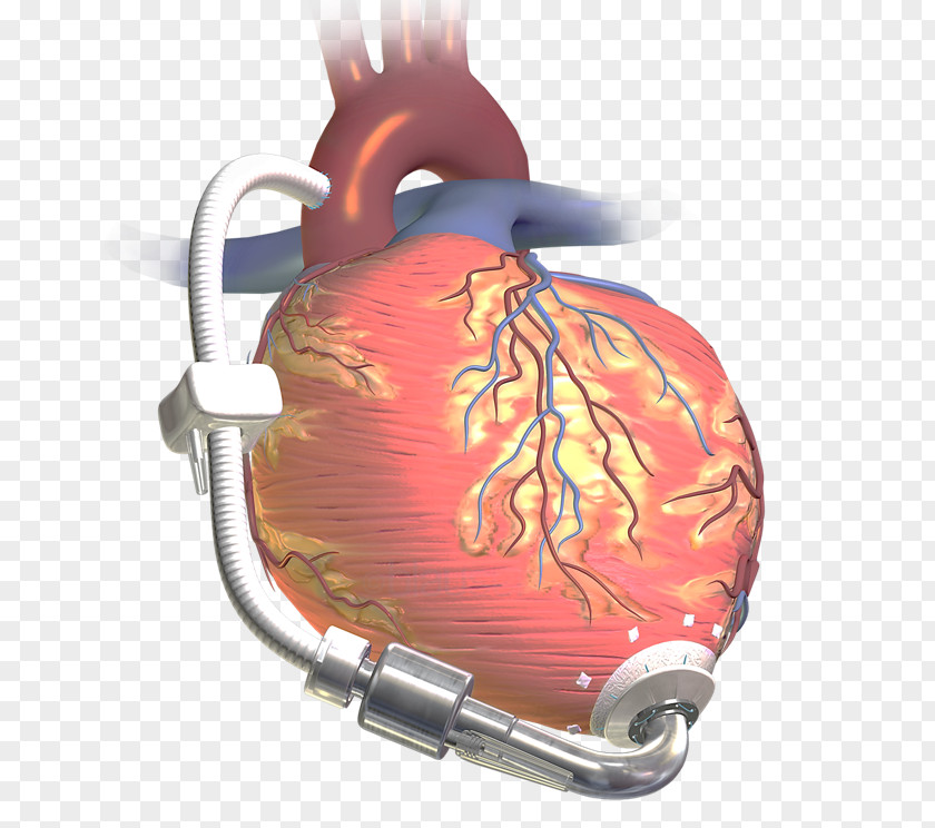 Heart Ventricular Assist Device Transplantation Artificial Hardware Pumps PNG
