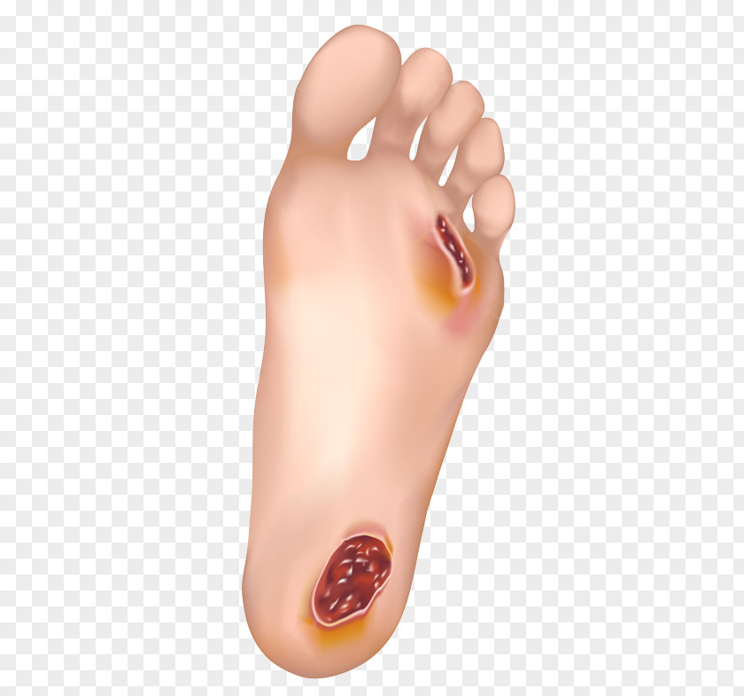 Wound Diabetic Foot Ulcer Diabetes Mellitus Disease Podiatrist PNG