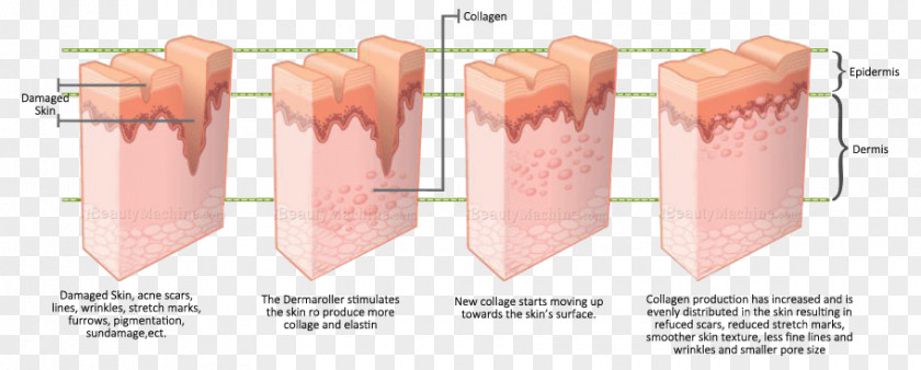 Within Broken Up Collagen Induction Therapy Dermis Skin Care PNG