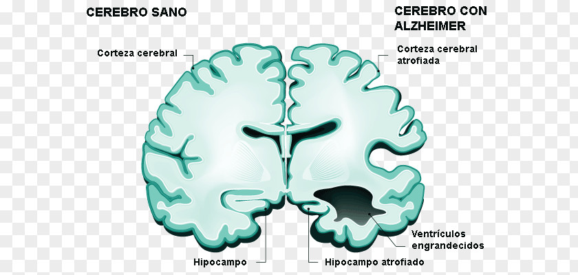 Memórias De Montevidéu Alzheimer's Disease Meningitis Vector Graphics Meningococcus Human Brain PNG