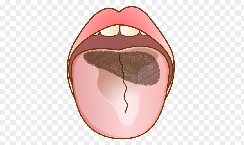 Tongue 歯科 Dentist Mouth Bad Breath PNG