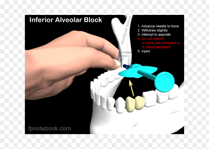 Syringe Needle Inferior Alveolar Nerve Anaesthesia Posterior Superior Mandibular Block PNG