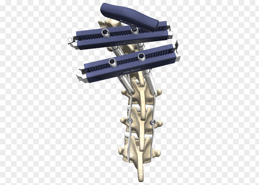 Vertebral Column Surgery Spinal Fusion Stryker Corporation PNG
