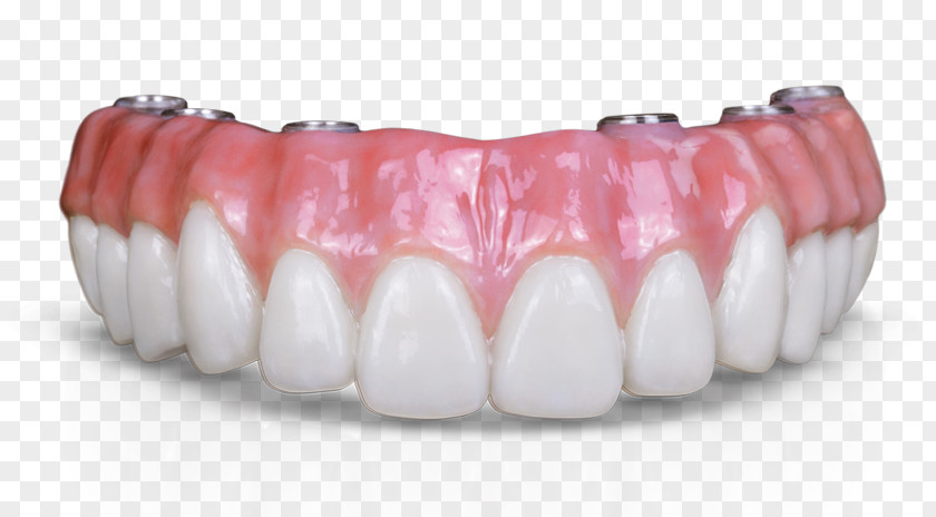 Dental Technology Implant Crown Dentures Bridge Dentistry PNG