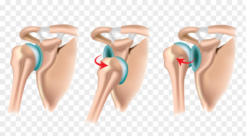 Arm Dislocated Shoulder Joint Dislocation Problem Impingement Syndrome PNG