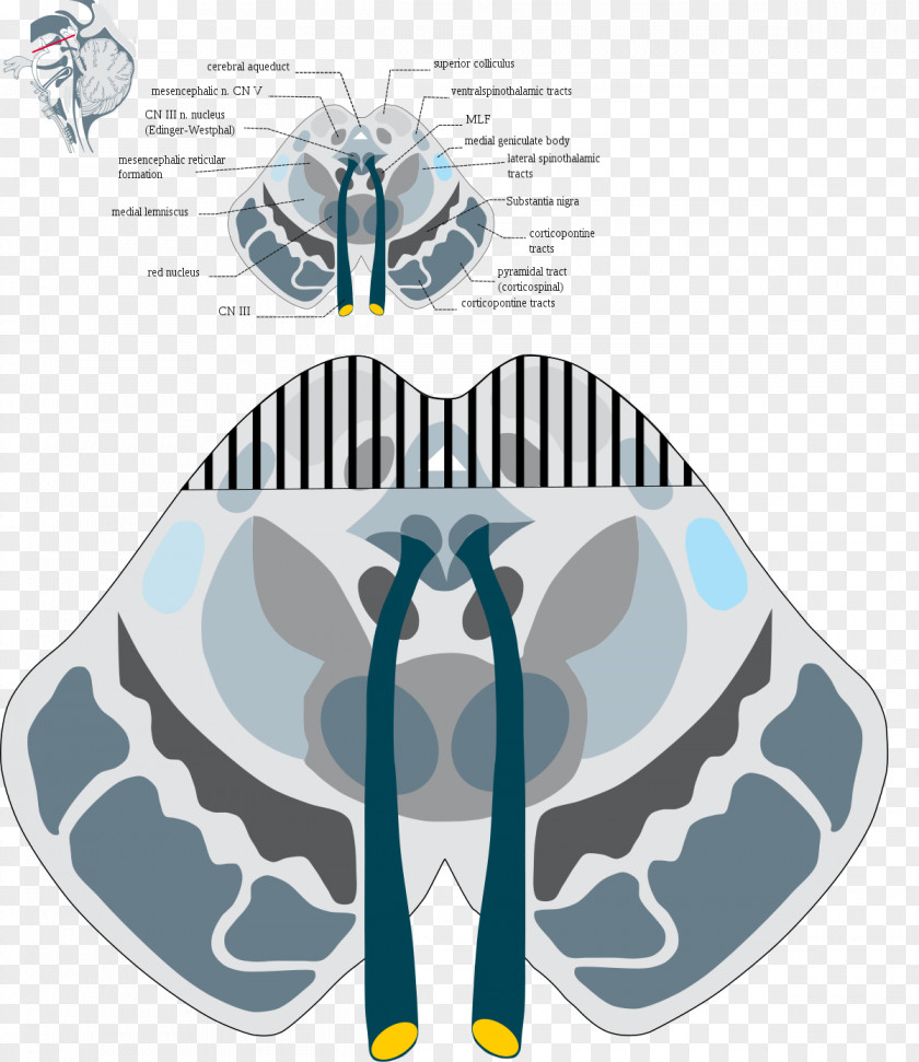 Delay Syndrome Parinaud's Weber's Gaze Benedikt Rostral Interstitial Nucleus Of Medial Longitudinal Fasciculus PNG