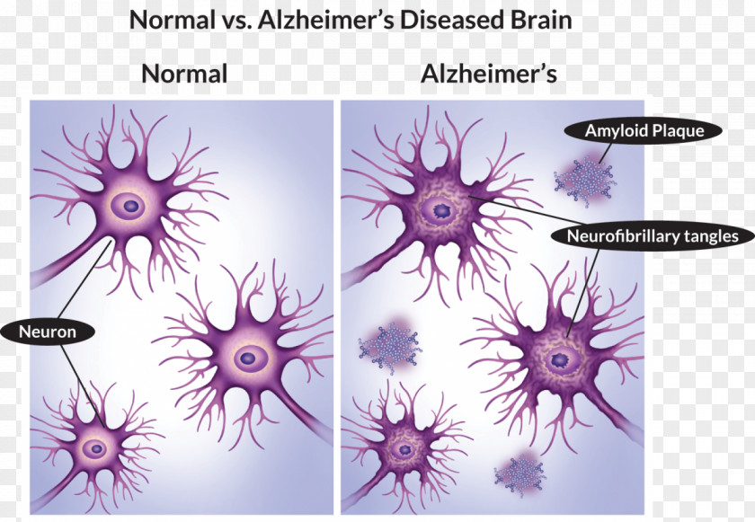 Alzheimers Disease Alzheimer's Stock Photography Health Medicine PNG