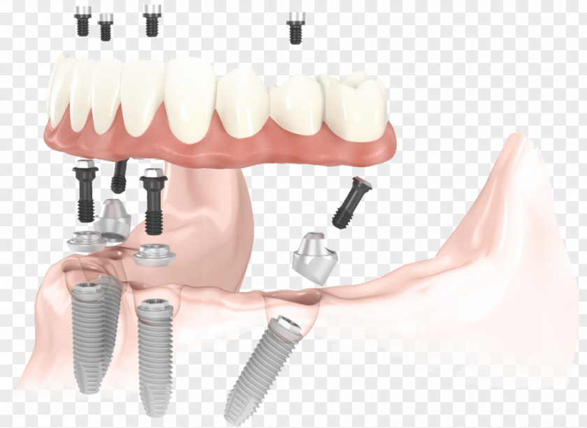 Bridge All-on-4 Dental Implant Dentistry PNG