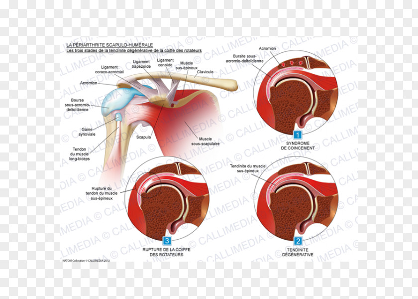 Degenerate Rotator Cuff Tear Tendinitis Tendinopathy Tendon PNG