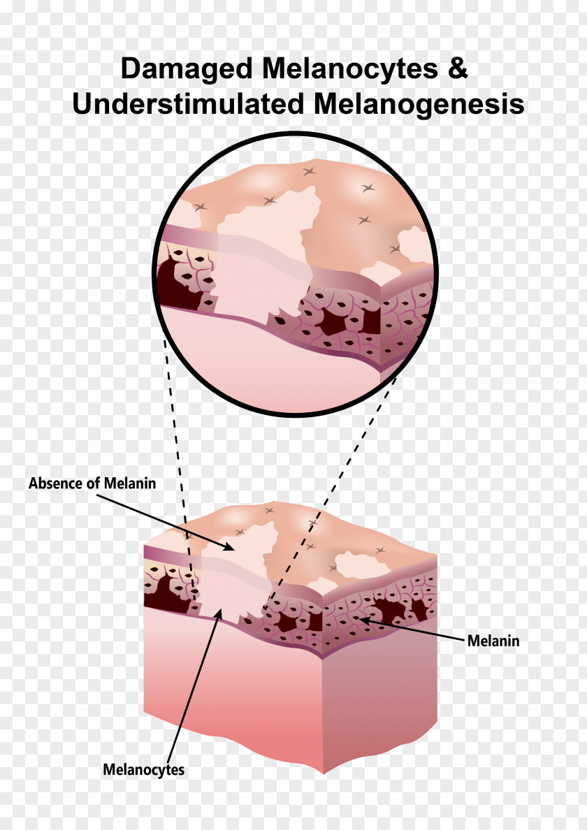 Scar Tissue Cells Melanocyte Melanin Hypopigmentation Skin PNG