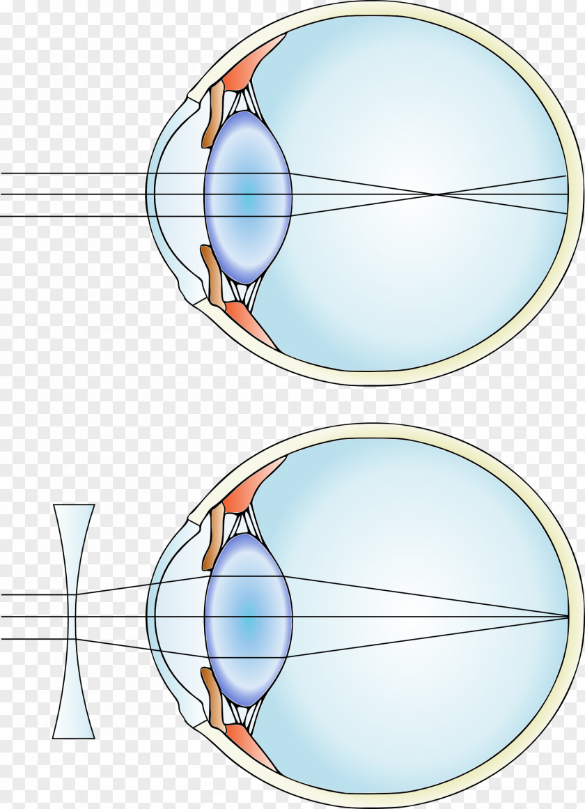 Dye Near-sightedness Hypermetropia Corrective Lens Eye PNG