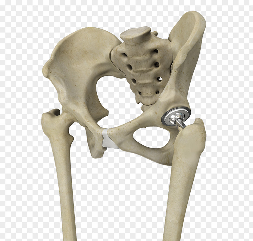 Hip Replacement Joint Surgery Knee PNG