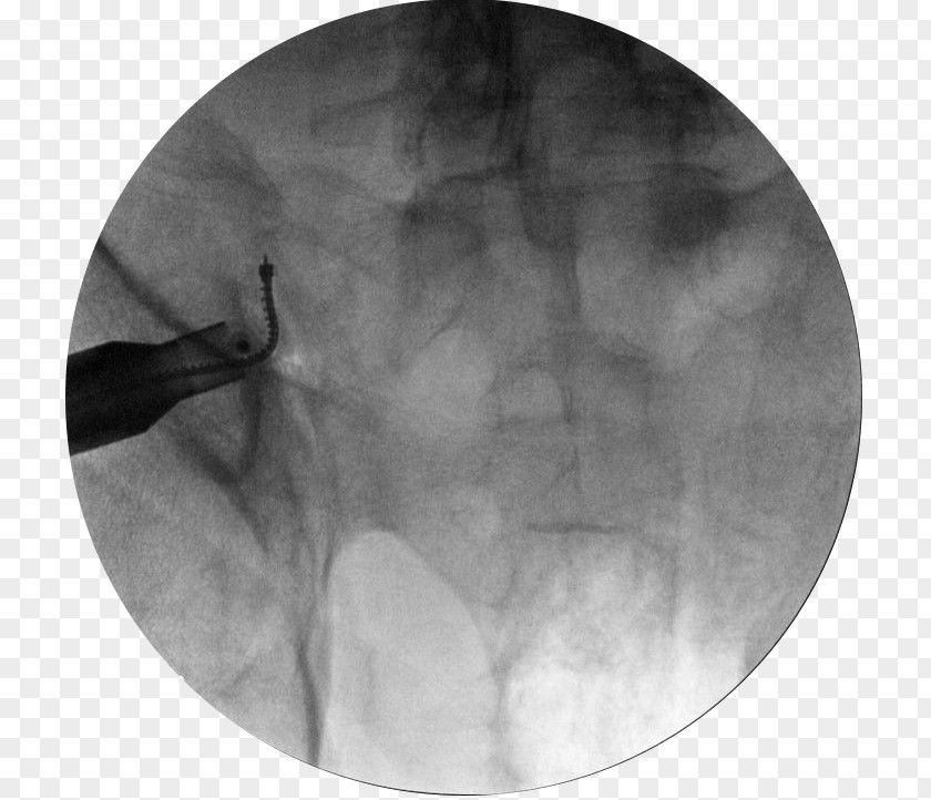 Sacroiliac Joint Dysfunction White PNG