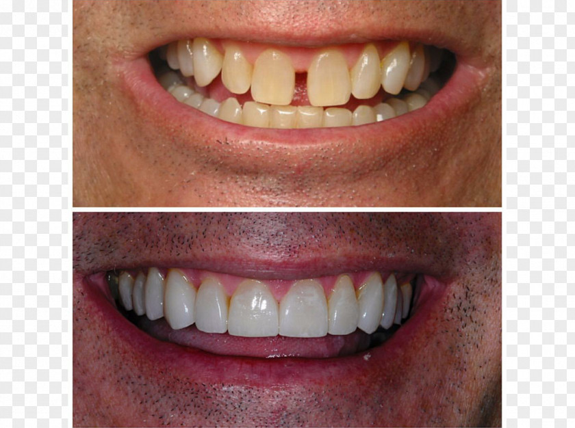 Crown Tooth Veneer All-on-4 Dental Implant Dentistry PNG