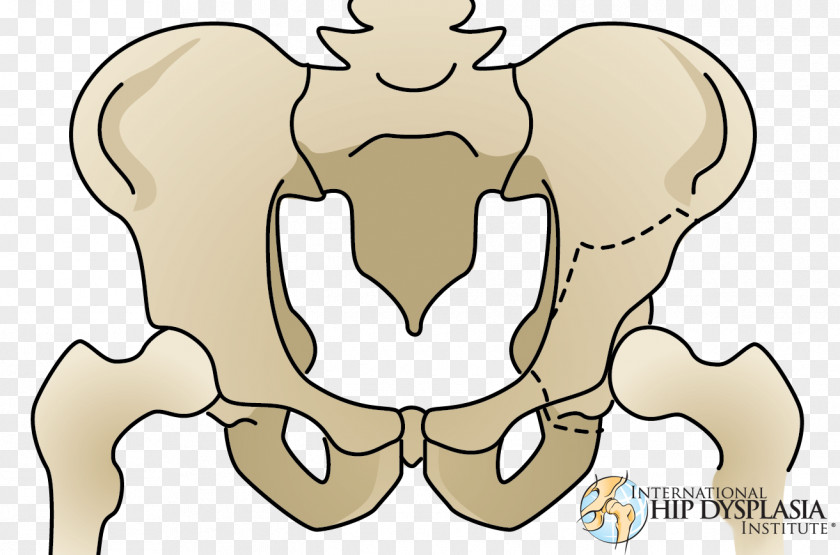 Pelvic Osteotomy Hip Dysplasia Acetabulum Pelvis PNG