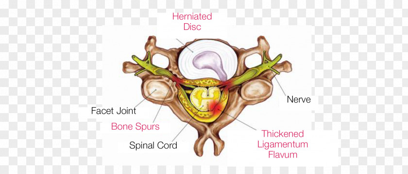 Neck Pain Radiculopathy Nerve Compression Syndrome Vertebral Column Cervical Vertebrae PNG