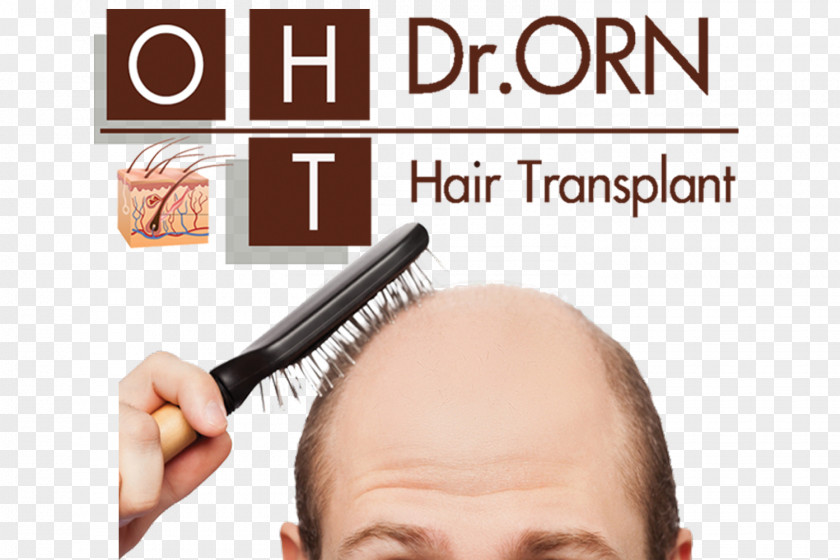 Hair Management Of Loss Transplantation Platelet-rich Plasma Therapy PNG