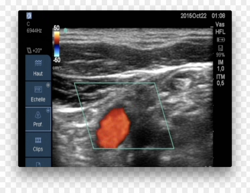 Blood Flow Medical Imaging Carotid Ultrasonography Doppler Echocardiography Ultrasound PNG