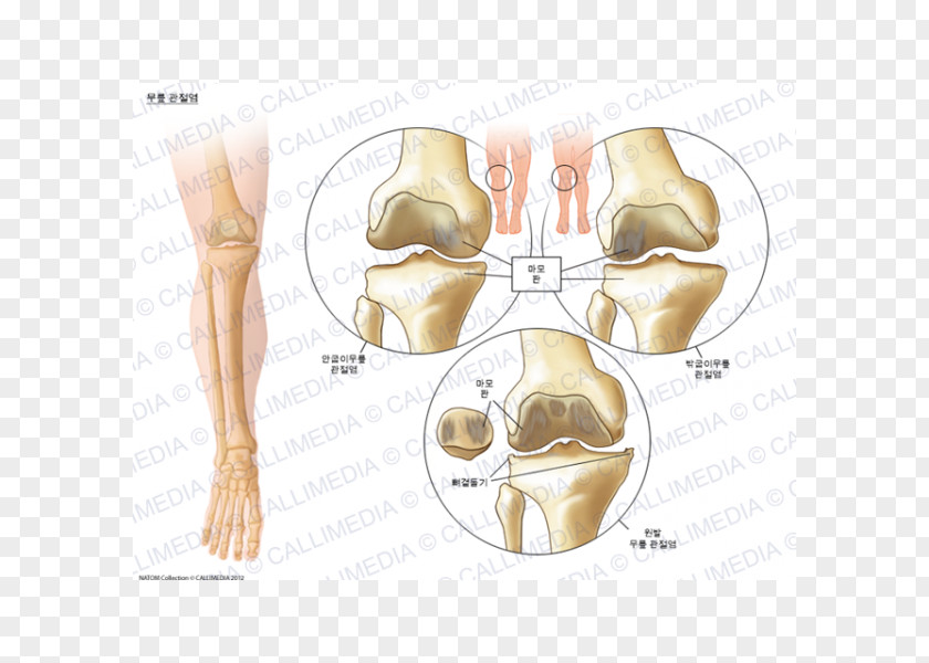 Ráº¯n 3d Knee Arthritis Osteoarthritis Pain PNG
