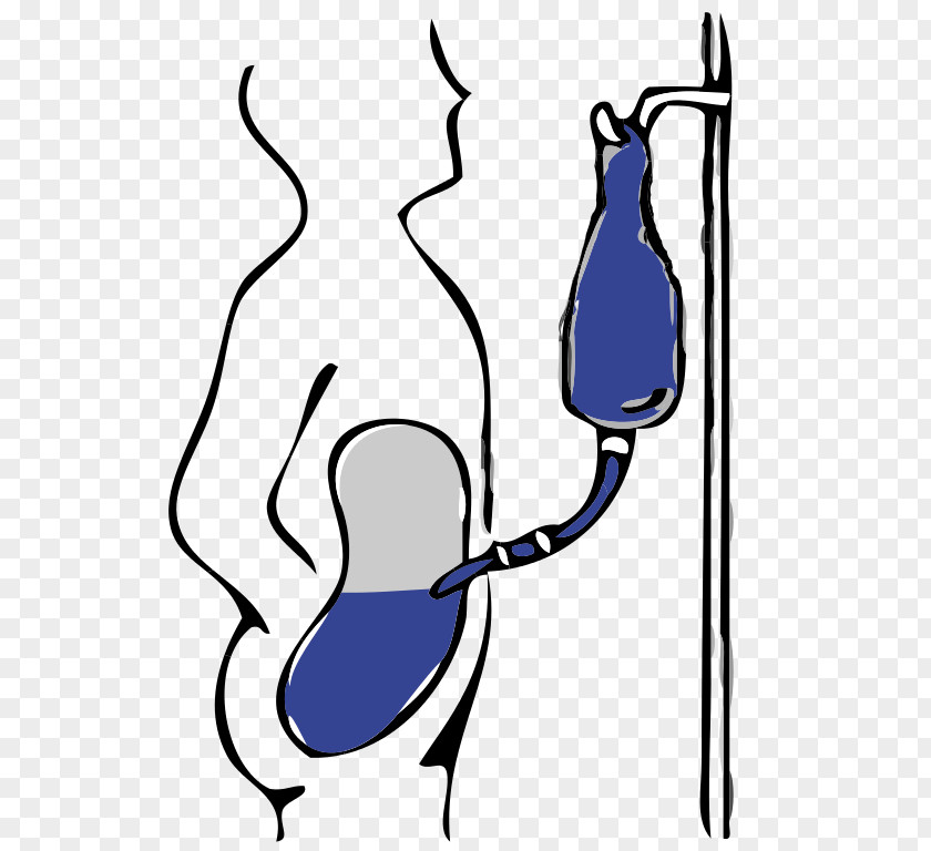 Peritoneal Dialysis Hemodialysis Peritoneum Icodextrin PNG