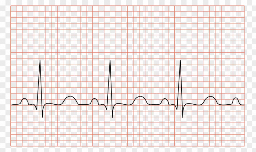 Heart Ventricular Tachycardia Electrocardiography Sinus PNG