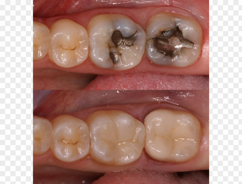 Cosmetic Treatment Tooth Dental Restoration Inlays And Onlays Crown Composite PNG