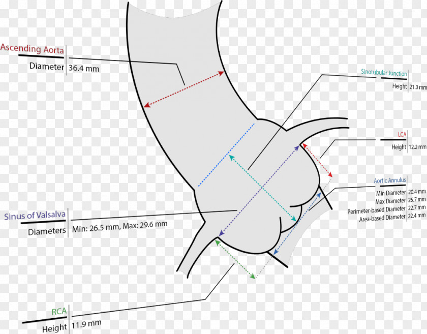 OMB Valves Size Conversion Percutaneous Aortic Valve Replacement Product Design Ascending Aorta PNG