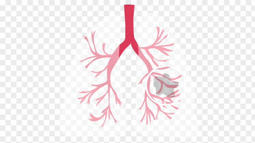 Lungs Non-small Cell Lung Cancer Cystic Fibrosis PNG