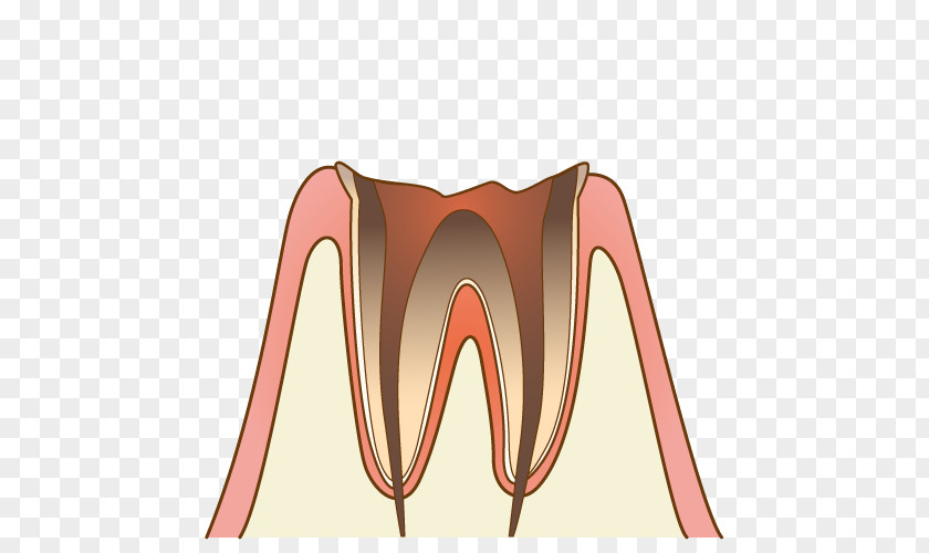 Tooth Cavity 歯科 Dentist Periodontal Disease Decay PNG