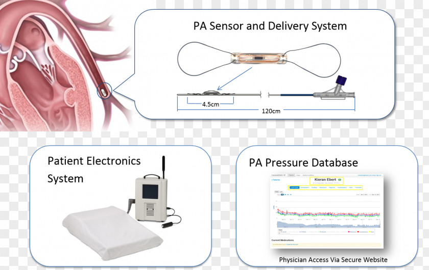 Heart Pulmonary Artery CardioMEMS Cardiac Catheterization Monitoring Cardiology PNG