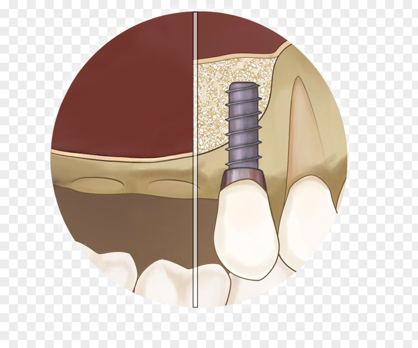Sinus Lift Maxillary Dental Implant PNG