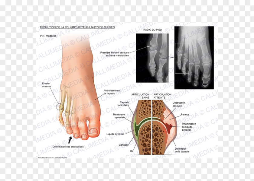 Ráº¯n 3d Rheumatoid Arthritis Joint Pain Rheumatology Stiffness PNG