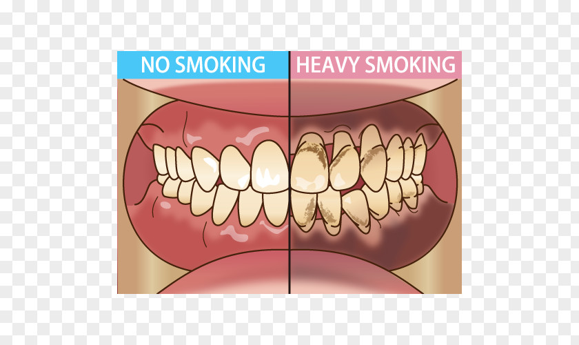 Tongue Tooth Dentist Periodontal Disease Tobacco Smoking 歯科 PNG