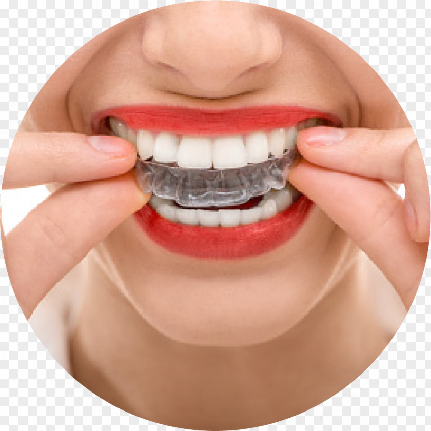 Decayed Tooth Orthodontics Dentistry Dental Braces Clear Aligners PNG