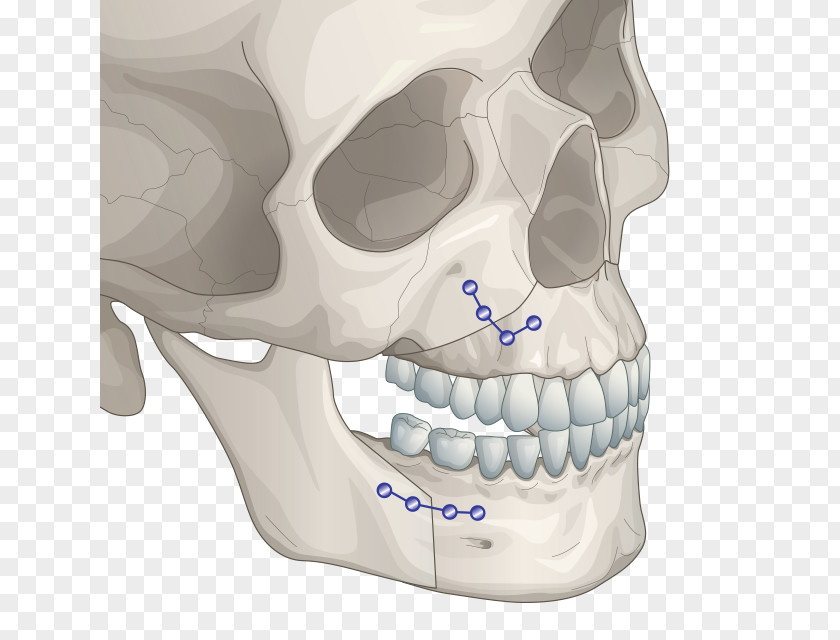 Face Jaw Orthognathic Surgery Chin Plastic PNG