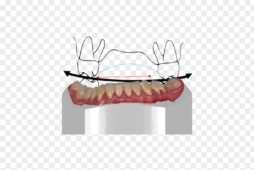 Right Key Orthodontics Tooth CAD/CAM Dentistry Orthodontic Technology PNG