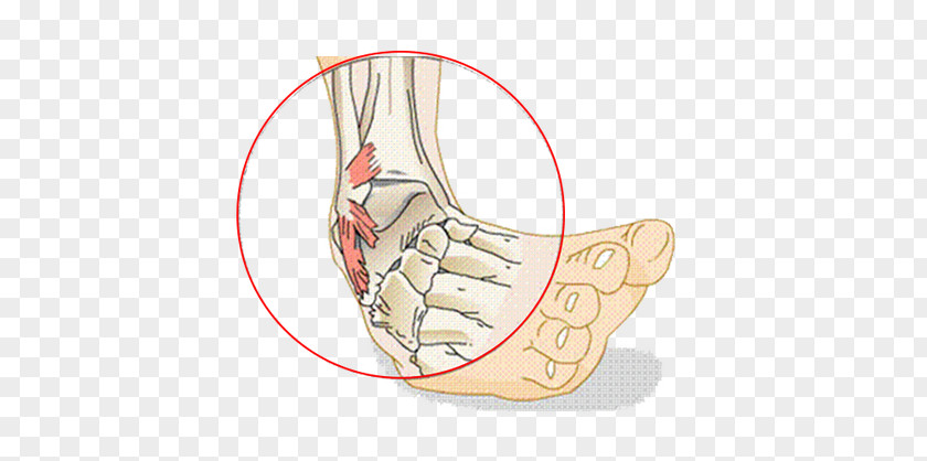 Sprained Ankle Ligament Injury PNG