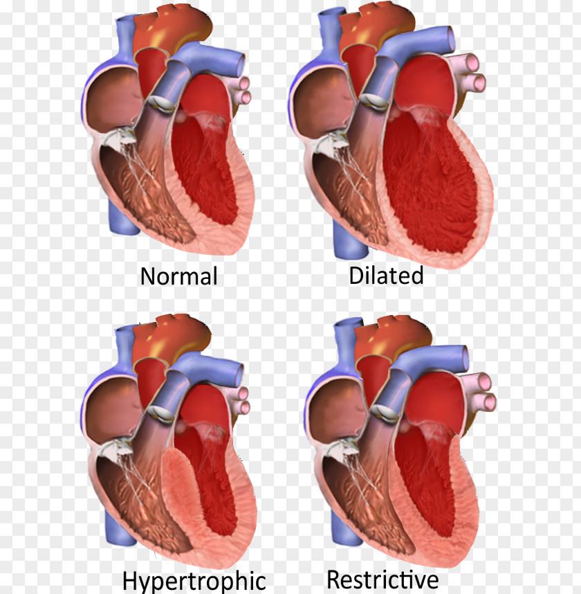 Heart Restrictive Cardiomyopathy Dilated Hypertrophic Cardiac Muscle PNG