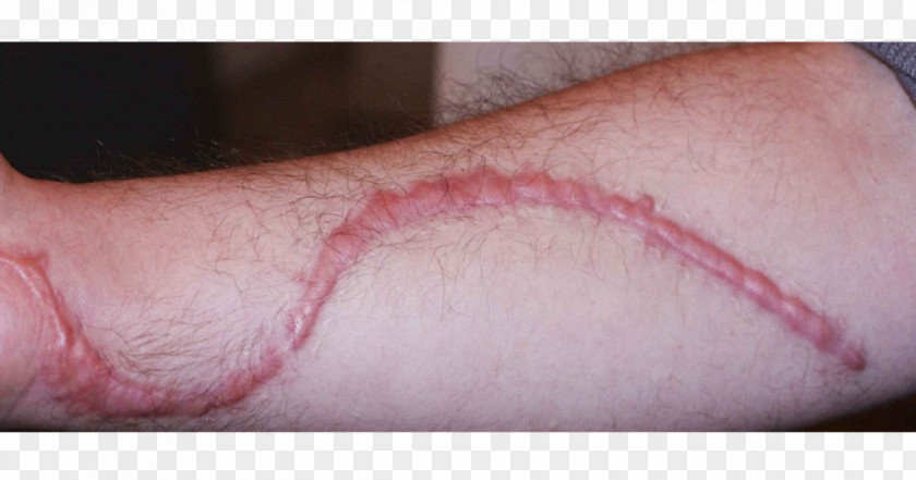 Scar Hypertrophic Koi Keloid Kefir PNG