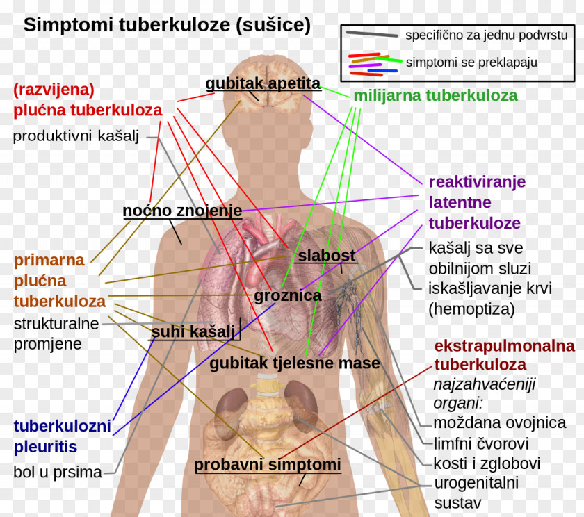 Health Latent Tuberculosis Infection Symptom Disease PNG