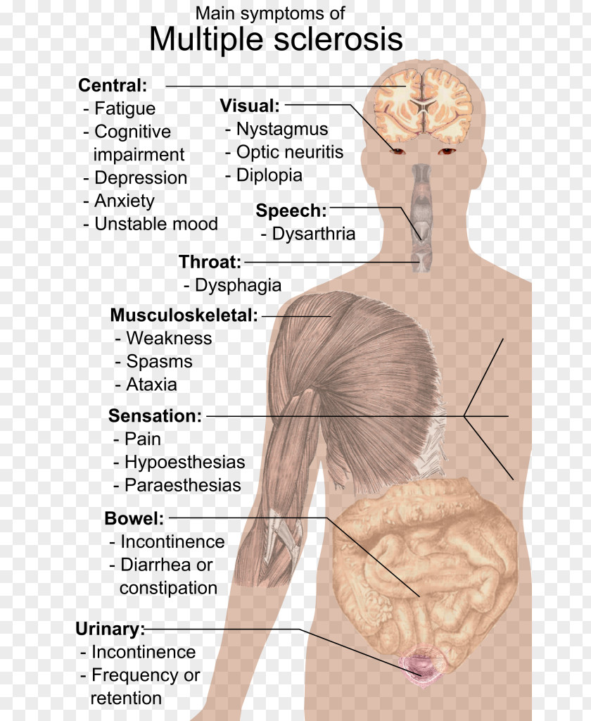 Multiple Sclerosis Signs And Symptoms Medical Sign Neck Pain PNG