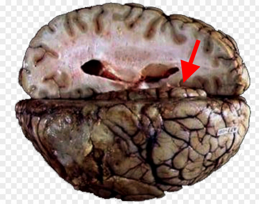 Brain Herniation Cerebellar Tentorium Tentorial Incisure Uncus Cingulate Gyrus PNG