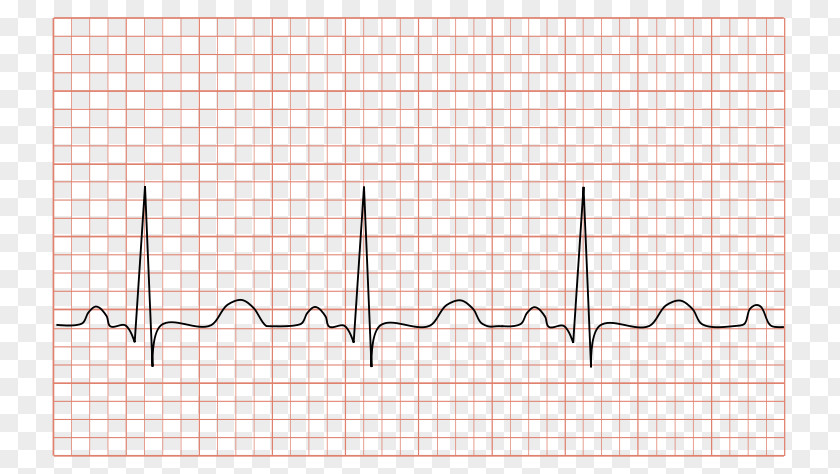 Svt Heart Rate Ecg Electrocardiography Sinus Tachycardia PNG