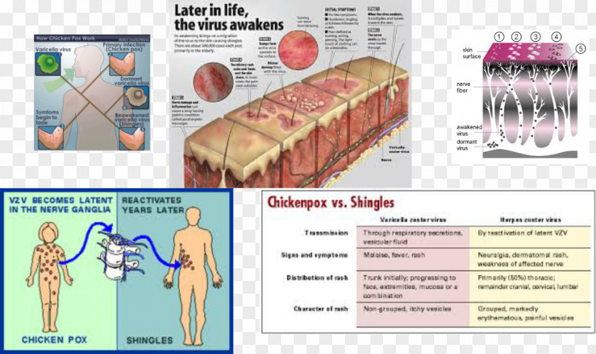 Herpes Zoster Muscle Advertising Organism Shingles PNG