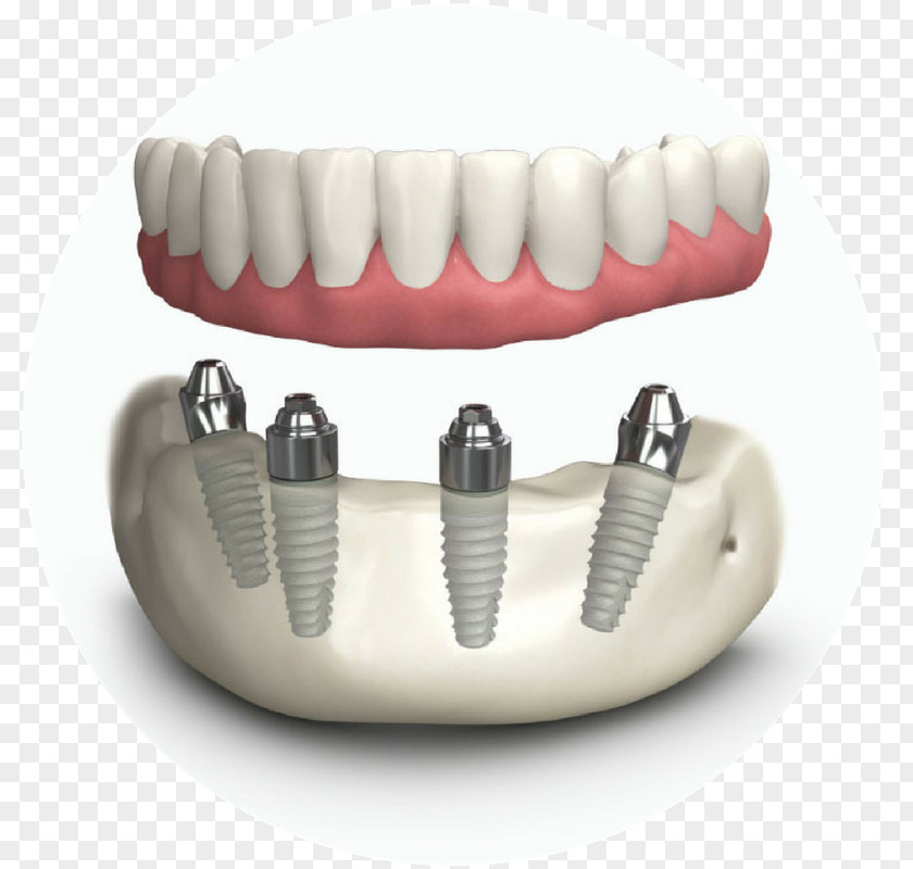 Tooth Dentures Dental Implant Dentistry PNG