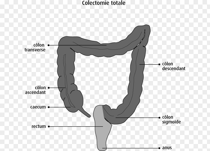 Diagnosis And Treatment Colectomy Bowel Resection Lower Anterior Surgery Ileo-anal Pouch PNG