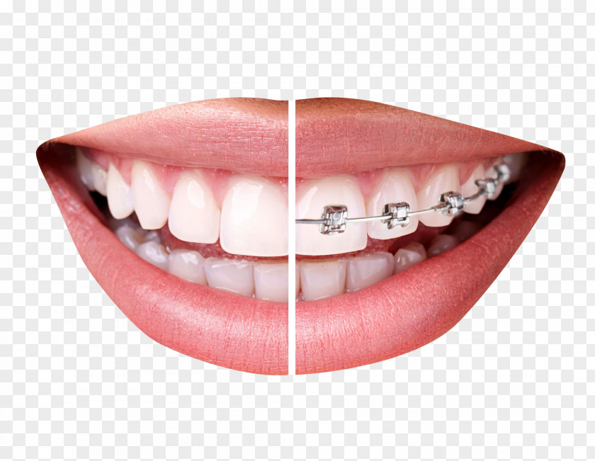 Teeth With Braces Dental Clear Aligners Orthodontics Tooth Dentistry PNG
