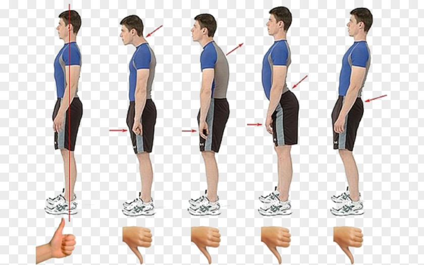 Health Scoliosis Poor Posture Neutral Spine Physical Therapy PNG